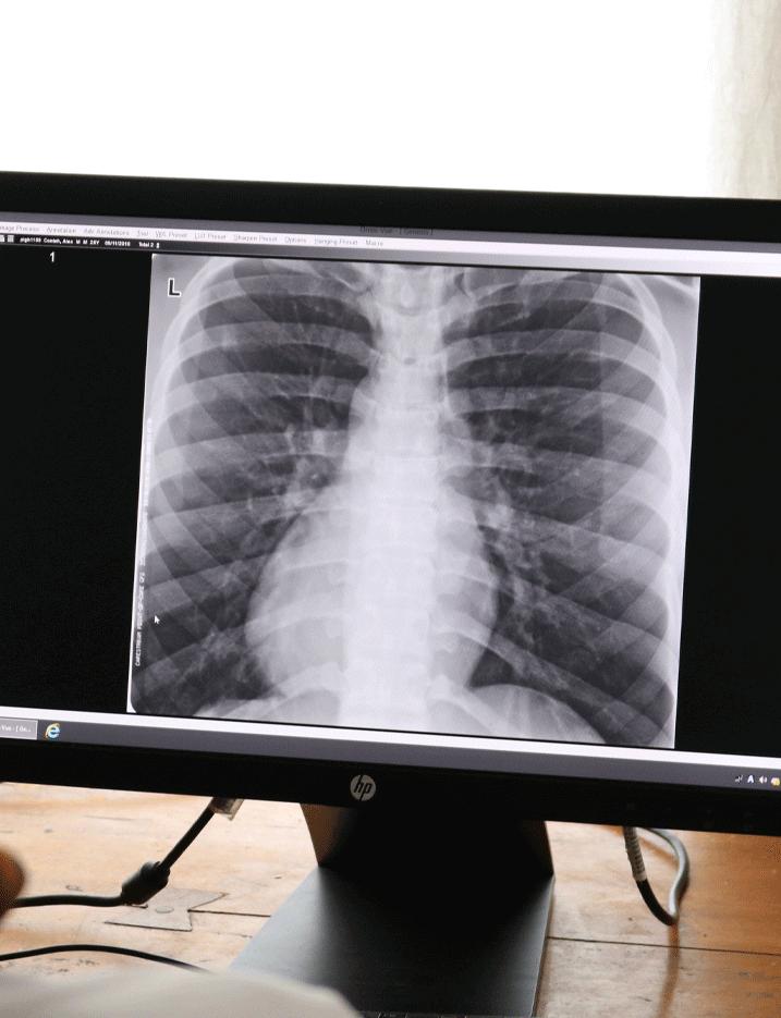 Solthis - Tuberculosis